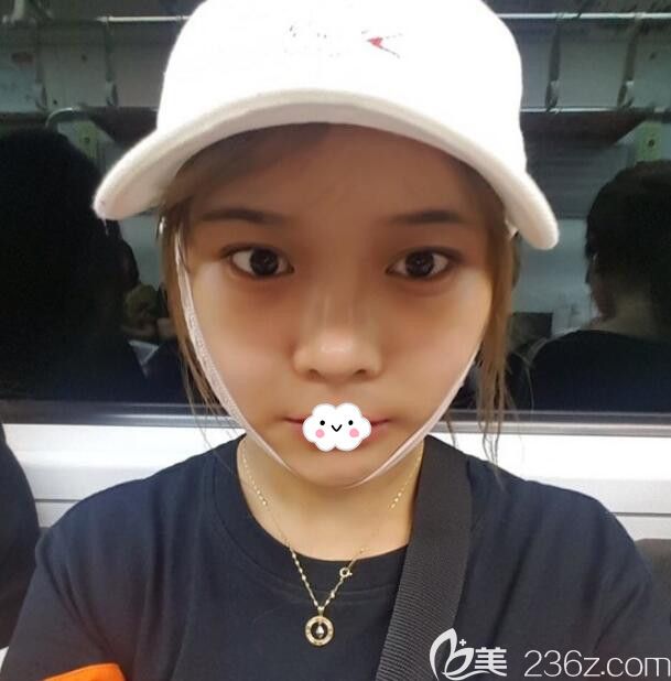 韓國eu整形面部輪廓三件套術(shù)后2周真實恢復(fù)圖 韓國eu整形面部輪廓三件套術(shù)后2周真實恢復(fù)圖