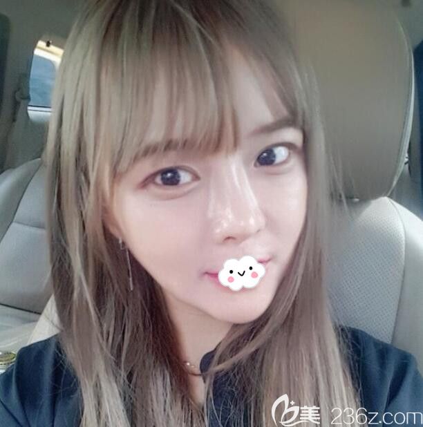 韓國eu整形顴骨降低+長曲線下頜角術(shù)后1個月 韓國eu整形顴骨降低+長曲線下頜角術(shù)后1個月