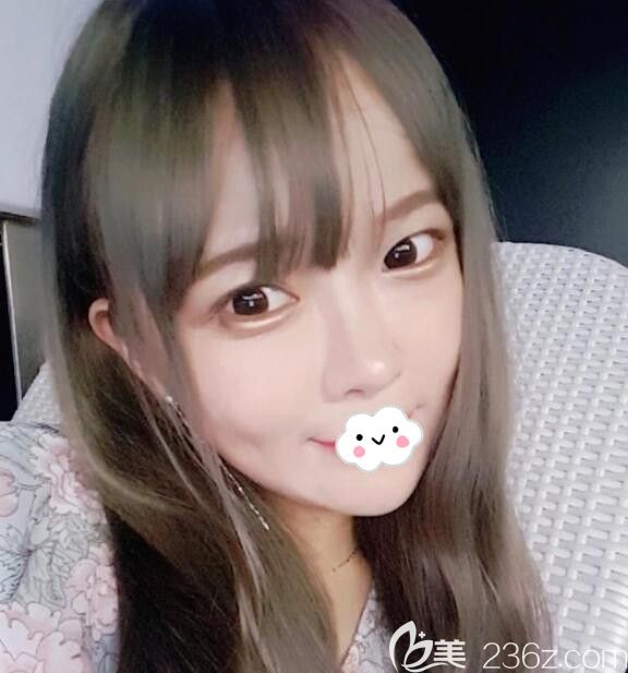 韓國eu整形醫(yī)院金鐘潤面部輪廓手術(shù)不插血袋，顴骨降低+長曲線下頜角術(shù)后有V-LINE瓜子臉