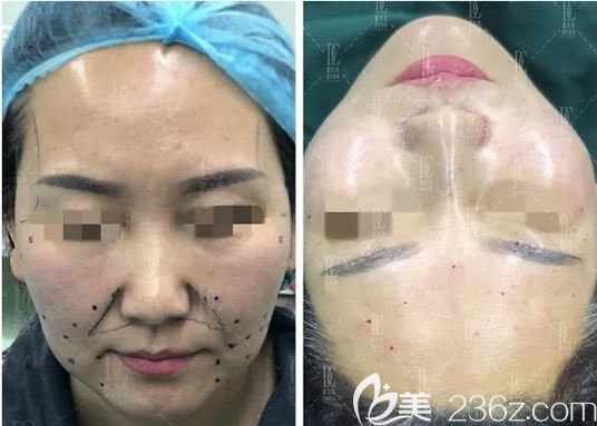  甘肅線雕哪家醫(yī)院好 蘭州崔大夫整形面部埋線提升+下頜緣吸脂即刻效果展示