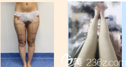大腿環(huán)吸術(shù)前術(shù)后對(duì)比照片 大腿環(huán)吸術(shù)前術(shù)后對(duì)比照片