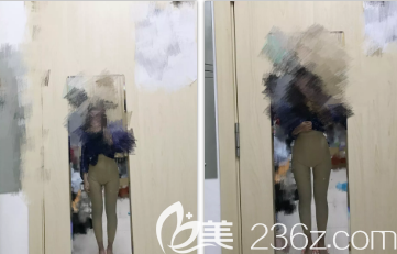 大腿環(huán)吸術(shù)后2個(gè)月的樣子 大腿環(huán)吸術(shù)后2個(gè)月的樣子