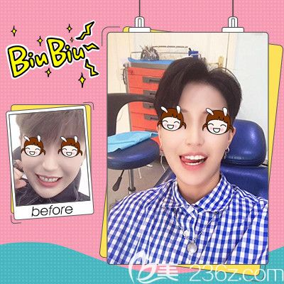 隱形牙齒矯正壹加壹真人案例術(shù)后恢復(fù)