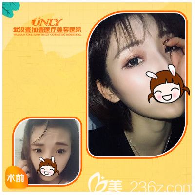 壹加壹做精切雙眼皮術(shù)后恢復(fù)效果