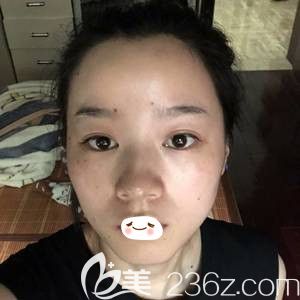 在張家口維多利亞做雙眼皮術(shù)前是內(nèi)雙眼皮 在張家口維多利亞做雙眼皮術(shù)前是內(nèi)雙眼皮