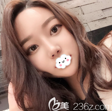 東莞西妃劉波做的鼻子真的太美了,說是媽生鼻也不為過哦