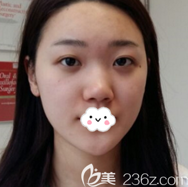 在東莞西妃做隆鼻術前照片 在東莞西妃做隆鼻術前照片