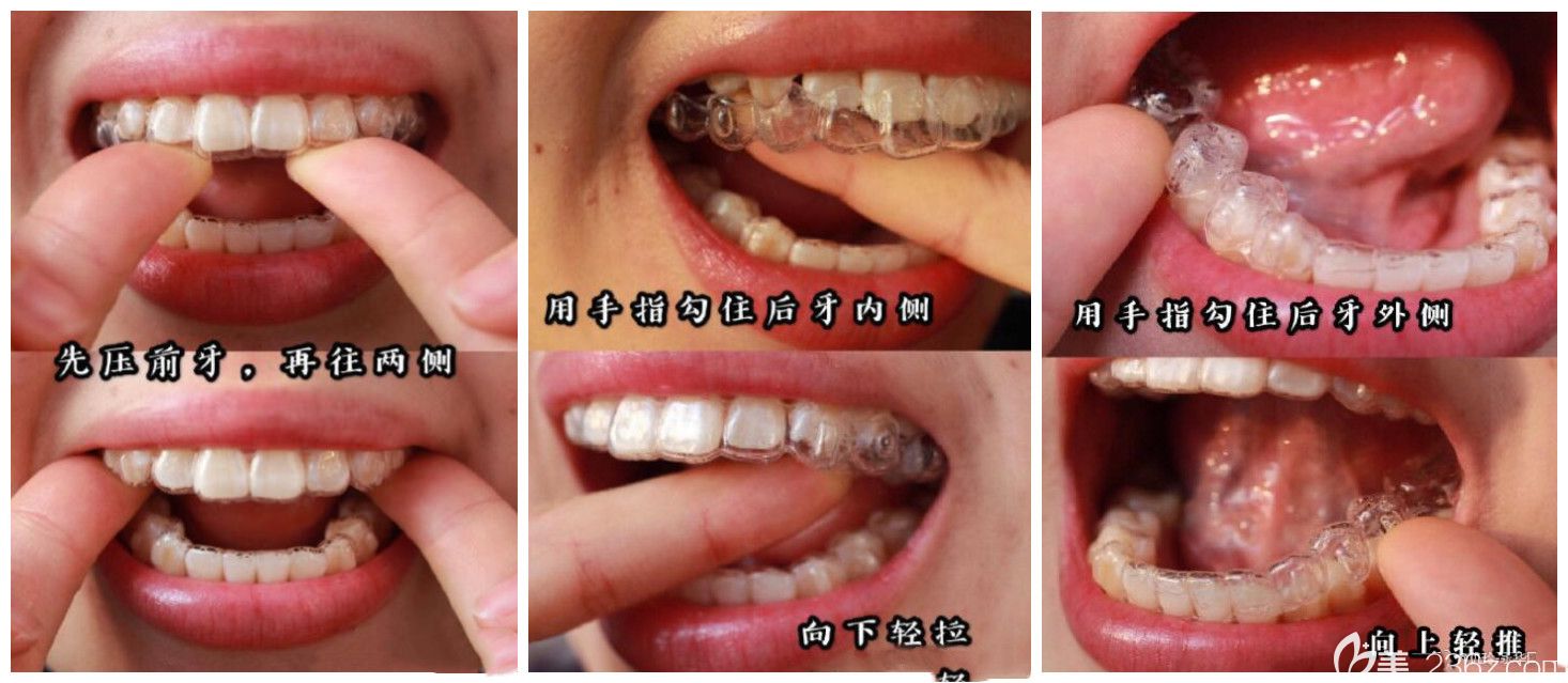 上海永華口腔醫(yī)生告訴大家隱形牙套正確摘戴方法 上海永華口腔醫(yī)生告訴大家隱形牙套正確摘戴方法