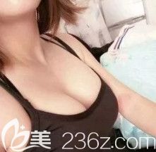 花樣年華假體手感硬嗎?反正我覺得在唐山蘇亞美聯(lián)臣找李春雷做的240cc假體隆胸手術效果自然還很柔軟