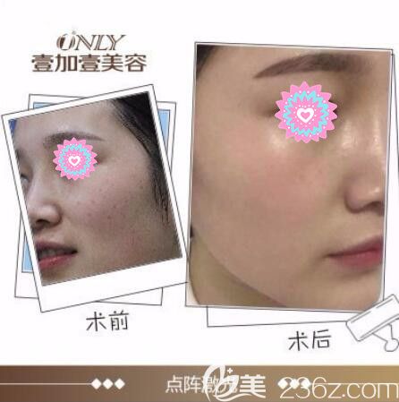 點(diǎn)陣極光祛斑有效果嗎？壹加壹極光祛斑案例供參考