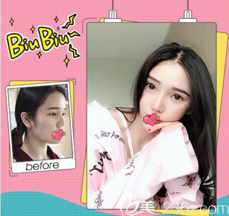 蕪湖壹加壹好不好？壹加壹雷中元肋軟骨隆鼻案例來驗(yàn)證