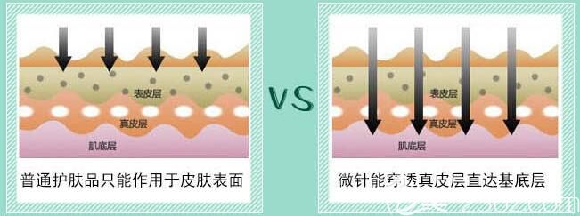 張春明醫(yī)生分享微針治療效果