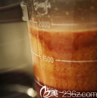 吸出來(lái)的脂肪圖片