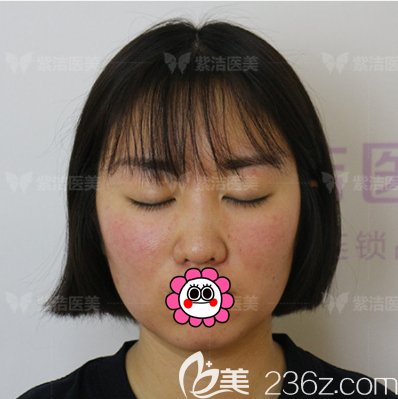 張金娥醫(yī)生給我做定點(diǎn)雙眼皮第5天樣子