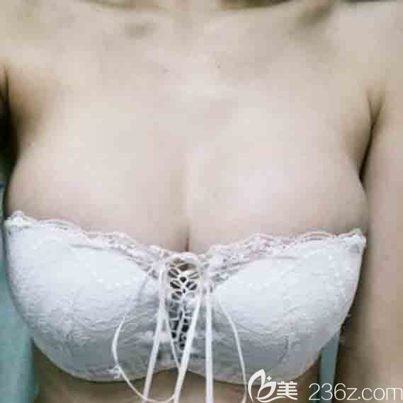 韓國(guó)UcanB整形外科隆胸修復(fù)真人案例 韓國(guó)UcanB整形外科隆胸修復(fù)真人案例