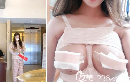 韓國(guó)UcanB整形外科假體隆胸修復(fù)術(shù)后第2天 韓國(guó)UcanB整形外科假體隆胸修復(fù)術(shù)后第2天