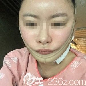 在韓國(guó)ARTLINE做面部吸手術(shù)當(dāng)天