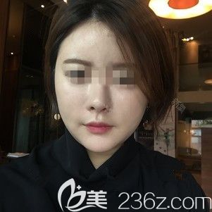 在韓國(guó)ARTLINE做面部吸術(shù)后2周