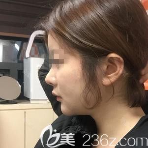 在韓國(guó)ARTLINE做面部吸術(shù)后1個(gè)月