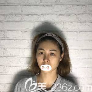 在張家口維多利亞做脂肪填充和雙眼皮術(shù)前是凹陷臉和單眼皮 在張家口維多利亞做脂肪填充和雙眼皮術(shù)前是凹陷臉和單眼皮