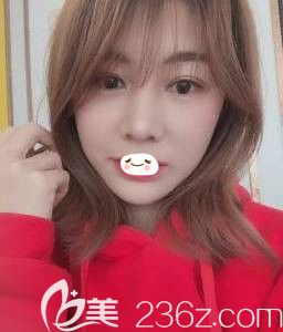 姜濤醫(yī)生為我做脂肪填充面部和雙眼皮術(shù)后1個(gè)月完全消腫 姜濤醫(yī)生為我做脂肪填充面部和雙眼皮術(shù)后1個(gè)月完全消腫