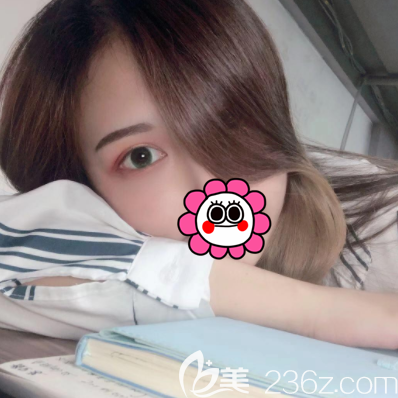 北京壹加壹埋線雙眼皮案例