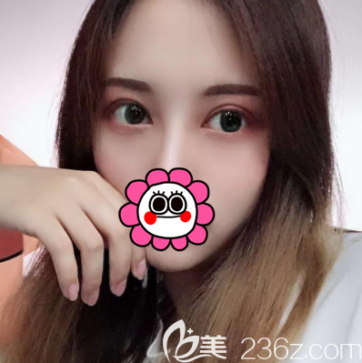 要問丁洪如做雙眼皮怎么樣就來欣賞我在北京壹加壹做埋線雙眼皮效果