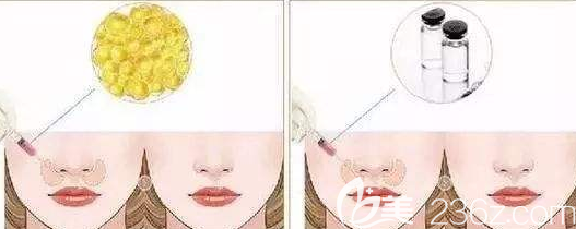 脂肪墊鼻基底和玻尿酸墊鼻基底的示意圖