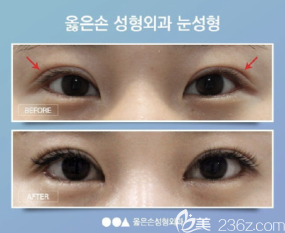 韓國righthand雙眼皮案例