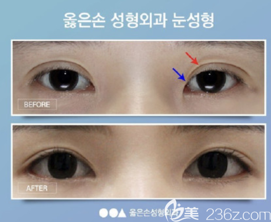 righthand家雙眼皮案例