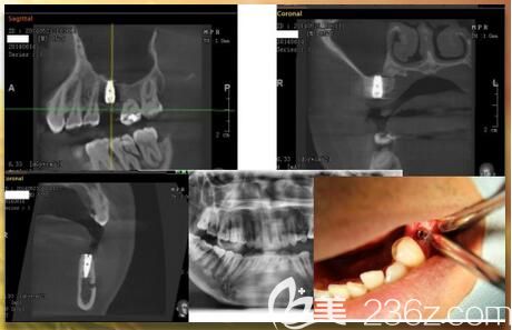 南寧柏樂口腔吳安世醫(yī)生種植牙技術(shù)優(yōu)勢(shì) 南寧柏樂口腔吳安世醫(yī)生種植牙技術(shù)優(yōu)勢(shì)