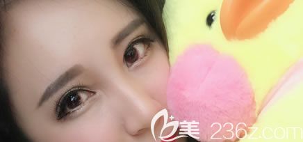 做完雙眼皮和隆鼻15天恢復(fù)圖片