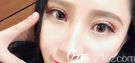 我是一例溫州藝星做神話眼綜合雙眼皮和肋骨鼻綜合整形案例,在這里分享我的親身經(jīng)驗(yàn)