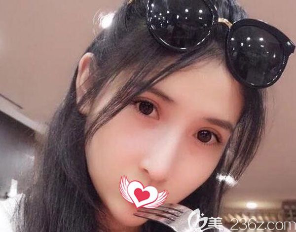 快來(lái)幫忙看看，我找院長(zhǎng)做肋軟骨隆鼻+耳軟骨墊鼻尖的效果怎么樣