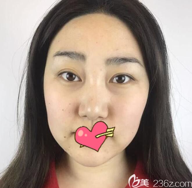 去合肥韓美整形做面部吸脂前照片 去合肥韓美整形做面部吸脂前照片