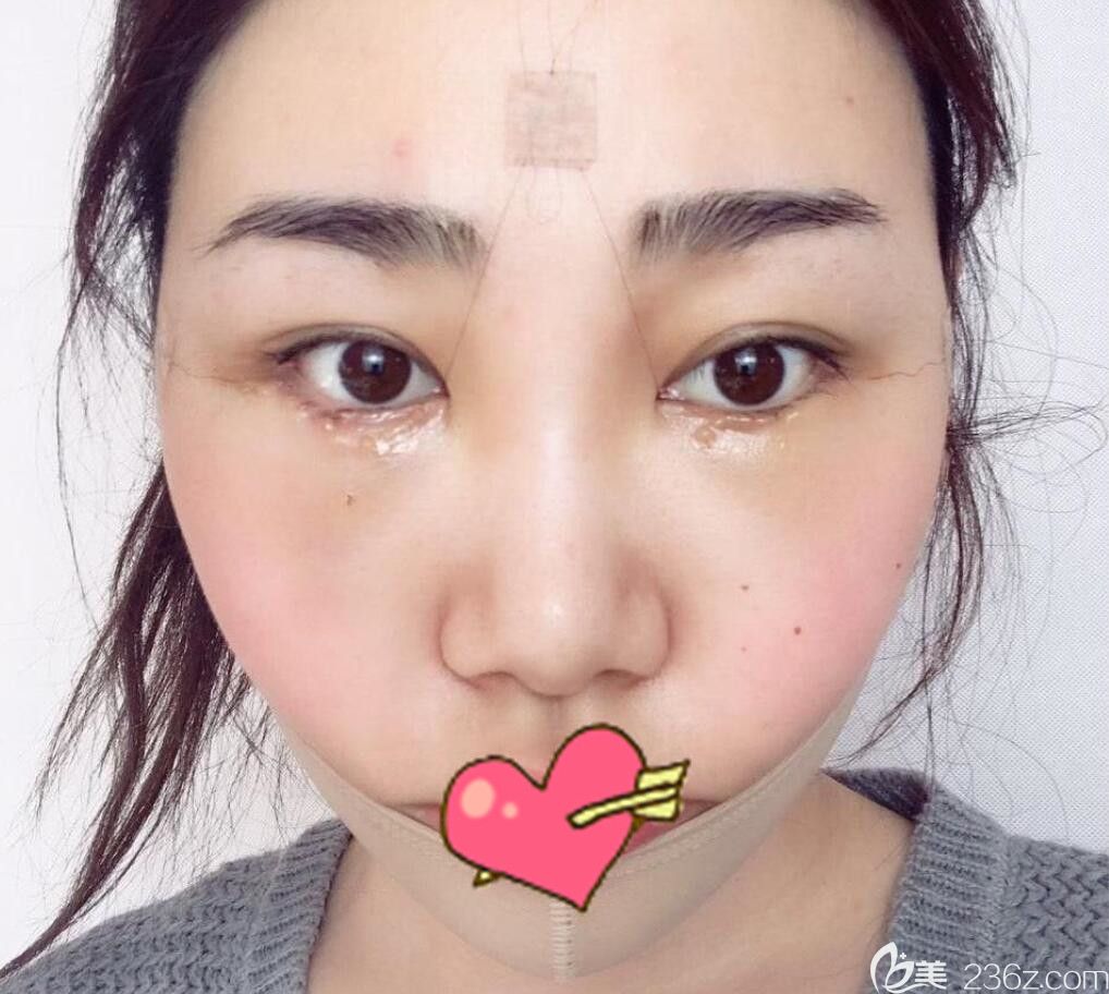 吸脂手術(shù)+全臉線雕+祛眼袋術(shù)后第3天 吸脂手術(shù)+全臉線雕+祛眼袋術(shù)后第3天