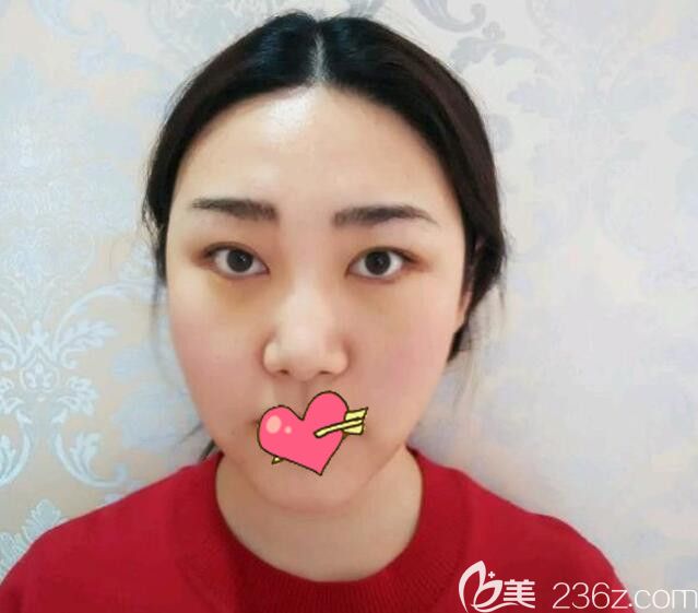 韓美整形面部吸脂第8天恢復(fù)情況 韓美整形面部吸脂第8天恢復(fù)情況