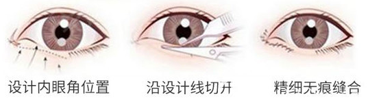深圳非凡我天生雙眼皮手術(shù)示意圖 深圳非凡我天生雙眼皮手術(shù)示意圖