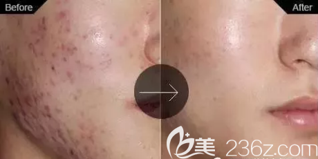 達(dá)州雙均祛痘治療前后對比效果
