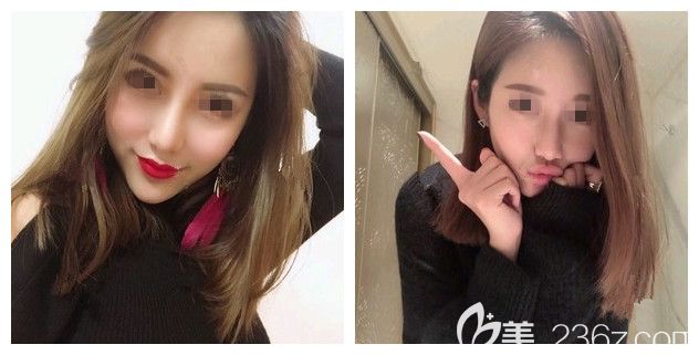 法令紋很深怎么辦?看無錫麗都案例教你用愛芙萊玻尿酸填充1ml的用量年輕5歲維持1年時(shí)間