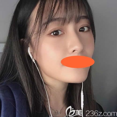 在西寧時(shí)光做自體脂肪填充全臉術(shù)后第15天 在西寧時(shí)光做自體脂肪填充全臉術(shù)后第15天