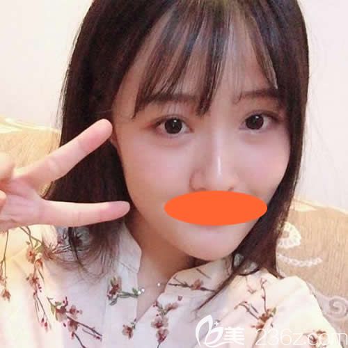 西寧哪家醫(yī)院可以做自體脂肪填充?看完我一個月前在西寧時光做脂肪填充全臉恢復圖及價格就知道了