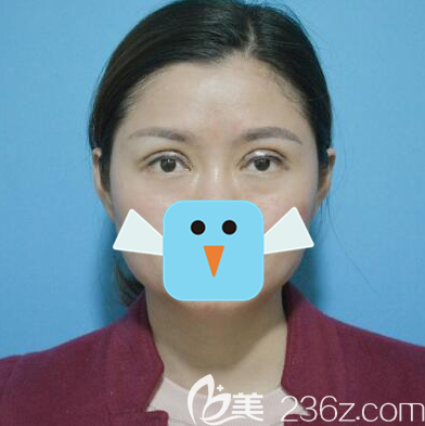 四川雙均李隆才眼修復術后即刻 四川雙均李隆才眼修復術后即刻