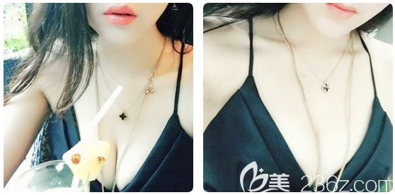 在廣州星團(tuán)醫(yī)美做完隆胸一個(gè)月了 在廣州星團(tuán)醫(yī)美做完隆胸一個(gè)月了