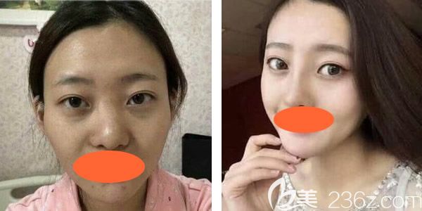 到西寧康華做自體脂肪填充全臉40天了，現(xiàn)在感覺(jué)填充過(guò)的地方飽滿緊致