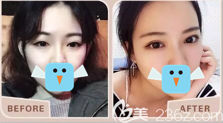 四川雙均雙眼皮效果展示