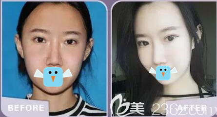 四川雙均隆鼻術(shù)前術(shù)后對比照片