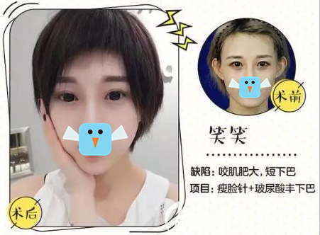 達(dá)州雙均瘦臉+玻尿酸豐下巴術(shù)后效果