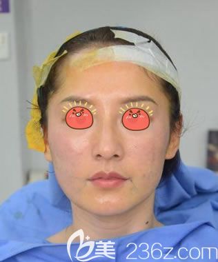 寧波美萊剛做完面部線雕圖片