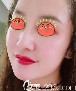 寧波美萊做面部線雕提升案例